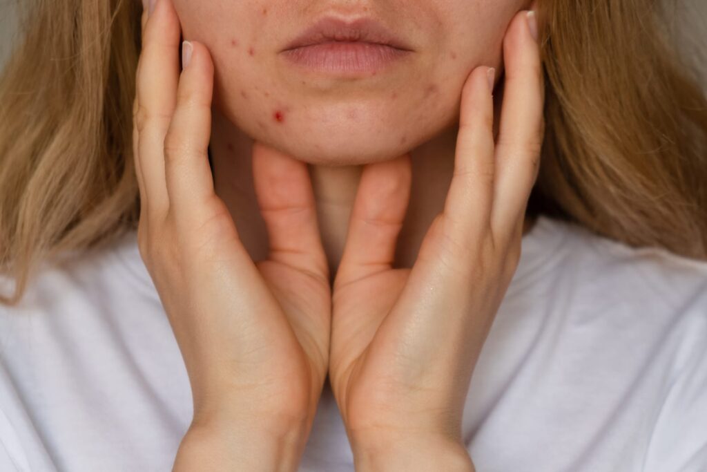 Jeune femme avec boutons d’acné au menton et sur la mâchoire, mains posées sur le visage